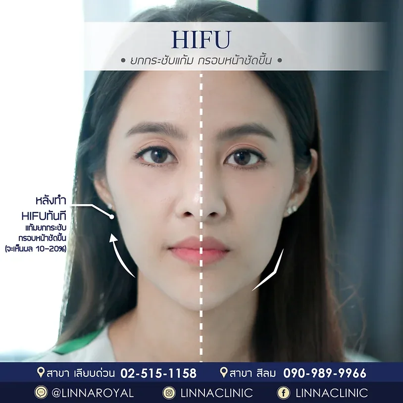 ทำให้หน้าเรียวอย่างปลอดภัย ด้วย 9 วิธี