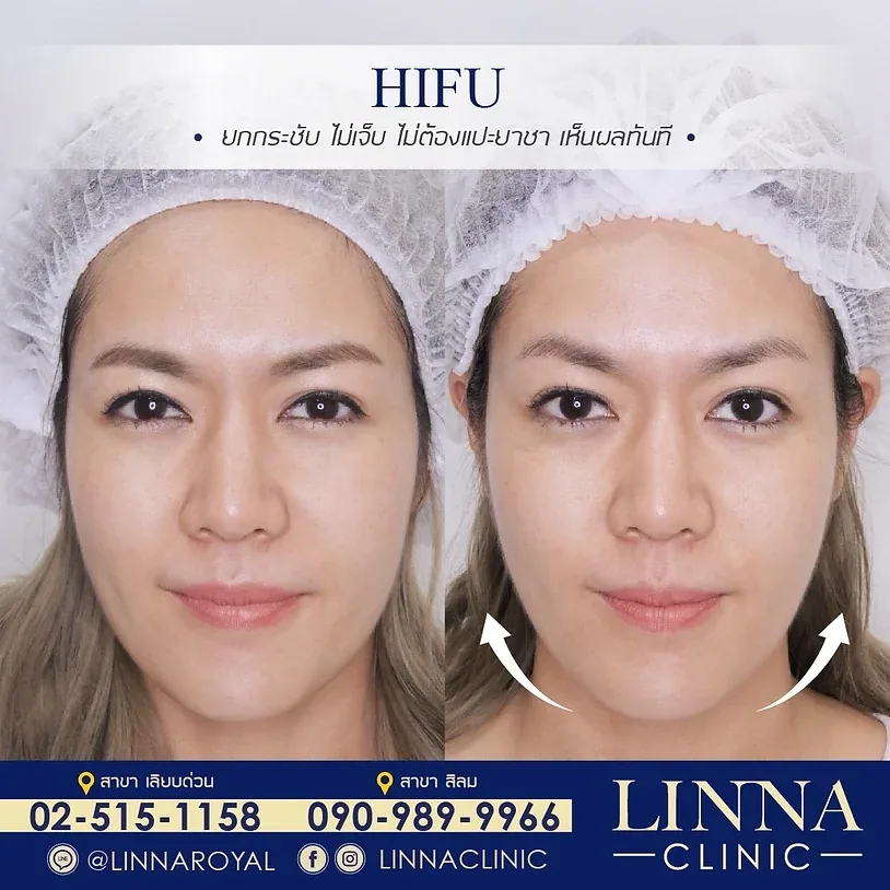 ทำให้หน้าเรียวอย่างปลอดภัย ด้วย 9 วิธี