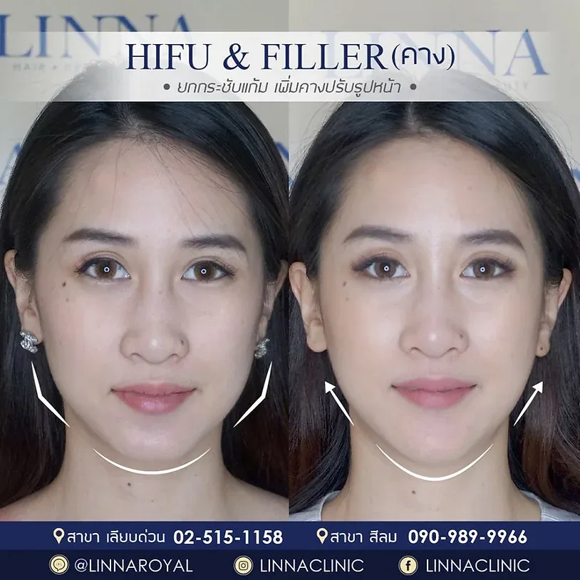 ทำให้หน้าเรียวอย่างปลอดภัย ด้วย 9 วิธี