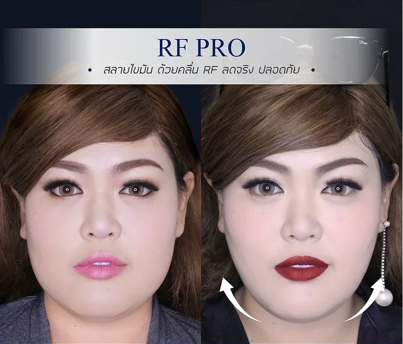 ทำให้หน้าเรียวอย่างปลอดภัย ด้วย 9 วิธี