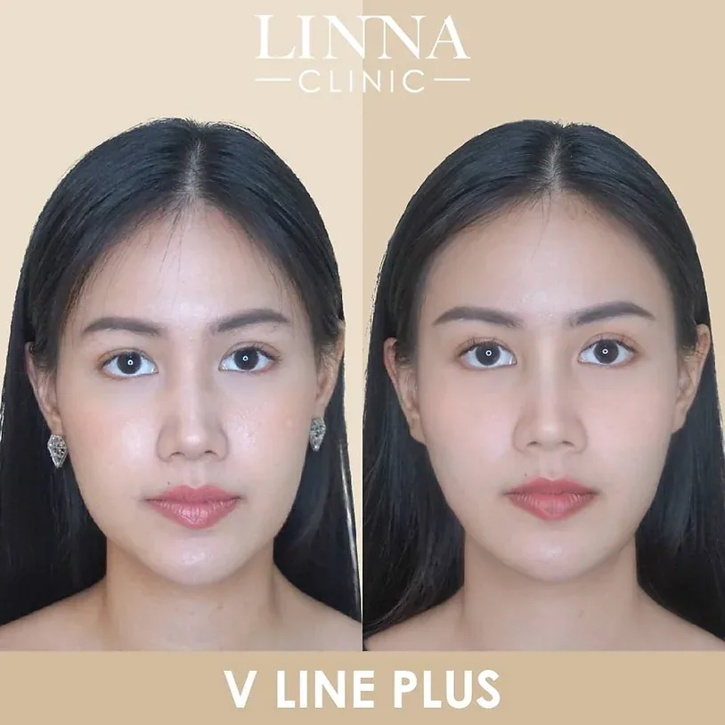 ทำให้หน้าเรียวอย่างปลอดภัย ด้วย 9 วิธี