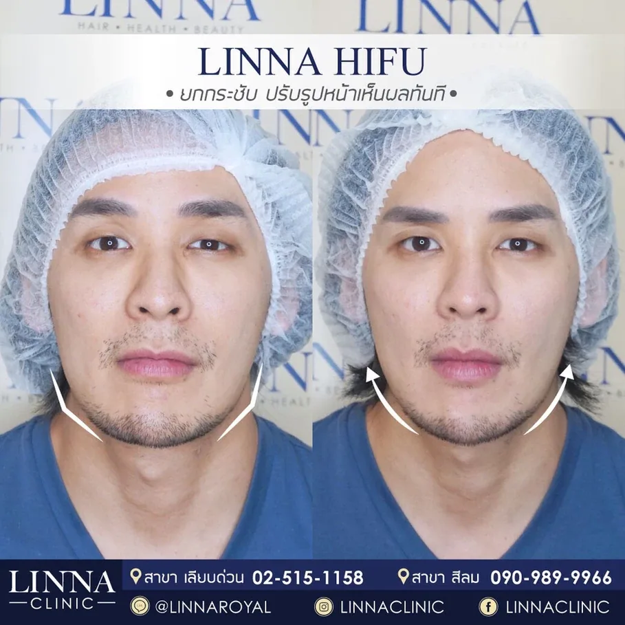 HIFU ราคาถูก ราคาแพง ผลต่างกันไหม แพงแล้วดีกว่าจริงไหม