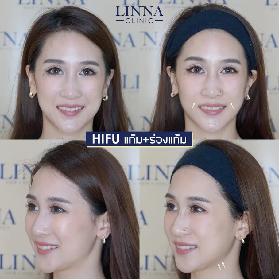 HIFU ราคาถูก ราคาแพง ผลต่างกันไหม แพงแล้วดีกว่าจริงไหม