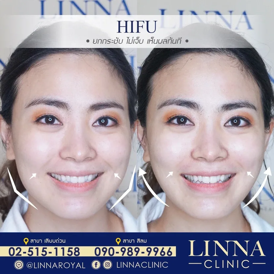 HIFU ราคาถูก ราคาแพง ผลต่างกันไหม แพงแล้วดีกว่าจริงไหม