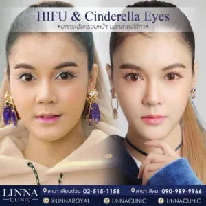 Cinderella Eyes ตัวเลือกใหม่สำหรับคนมีปัญหารอยคล้ำใต้ตา