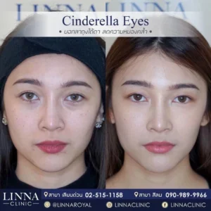 Cinderella Eyes ตัวเลือกใหม่สำหรับคนมีปัญหารอยคล้ำใต้ตา