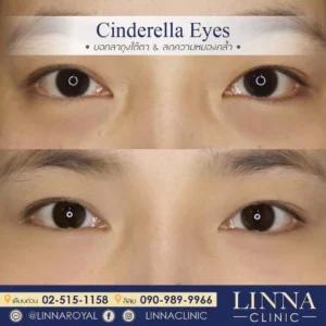 Cinderella Eyes ตัวเลือกใหม่สำหรับคนมีปัญหารอยคล้ำใต้ตา