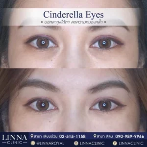 Cinderella Eyes ตัวเลือกใหม่สำหรับคนมีปัญหารอยคล้ำใต้ตา