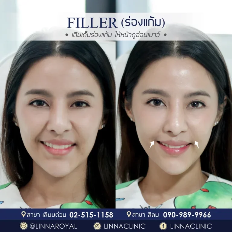 มีร่องแก้มลึก แก้ยังไงได้บ้าง