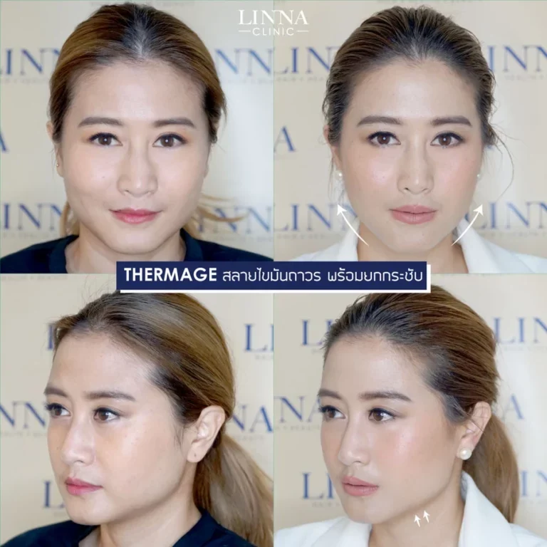 มีร่องแก้มลึก แก้ยังไงได้บ้าง