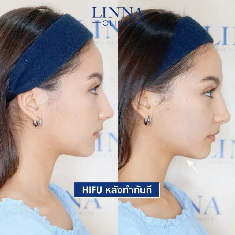 ทำ Hifu ต้องเจ็บหรือไม่เจ็บ ช่วยยกกระชับได้จริงไหม