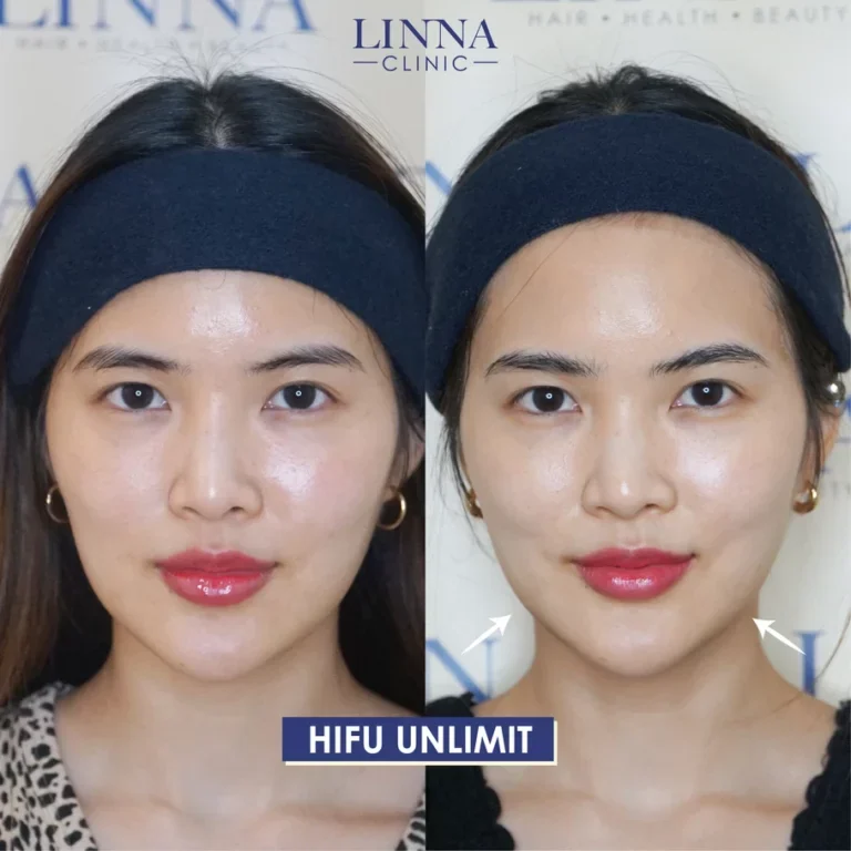 ทำ Hifu ต้องเจ็บหรือไม่เจ็บ ช่วยยกกระชับได้จริงไหม