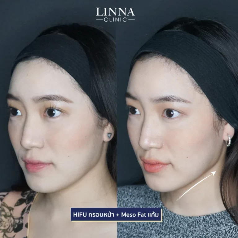 ทำ Hifu ต้องเจ็บหรือไม่เจ็บ ช่วยยกกระชับได้จริงไหม