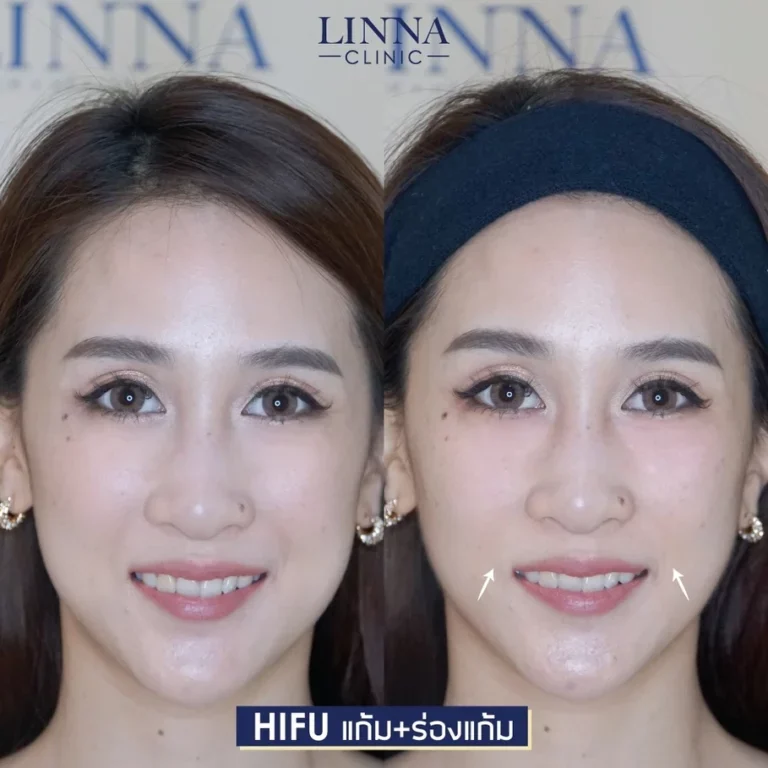 ทำ Hifu ต้องเจ็บหรือไม่เจ็บ ช่วยยกกระชับได้จริงไหม