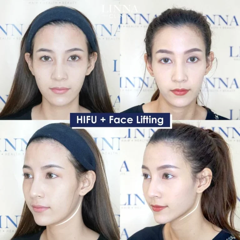ทำ Hifu ต้องเจ็บหรือไม่เจ็บ ช่วยยกกระชับได้จริงไหม