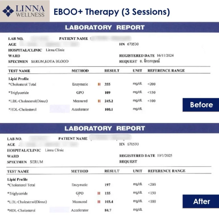 EBOO Therapy การบำบัดเพื่อฟื้นฟูหลอดเลือดหลังการฉีดวัคซีนโควิด-19