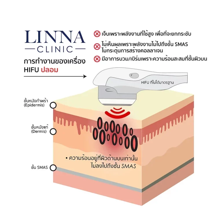 ทำ HIFU ปลอมแล้วจะเป็นอย่างไร มาดูกัน