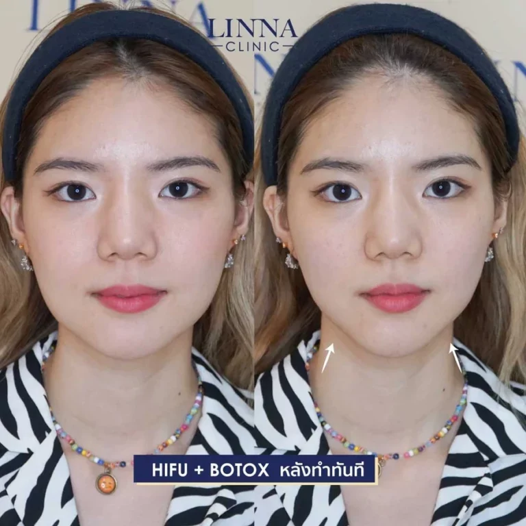 Hifu คืออะไร ยกกระชับจริงไหม รวมข้อเท็จจริงที่ต้องรู้