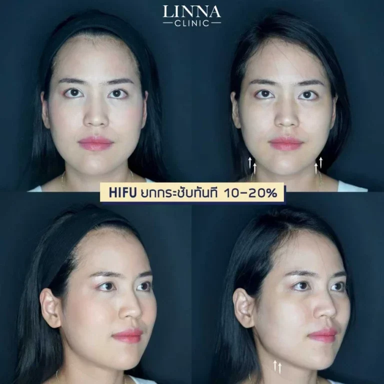 Hifu คืออะไร ยกกระชับจริงไหม รวมข้อเท็จจริงที่ต้องรู้