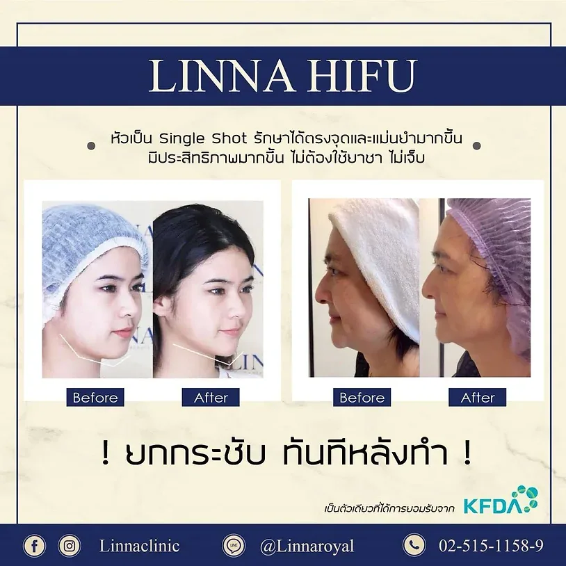 Hifu review