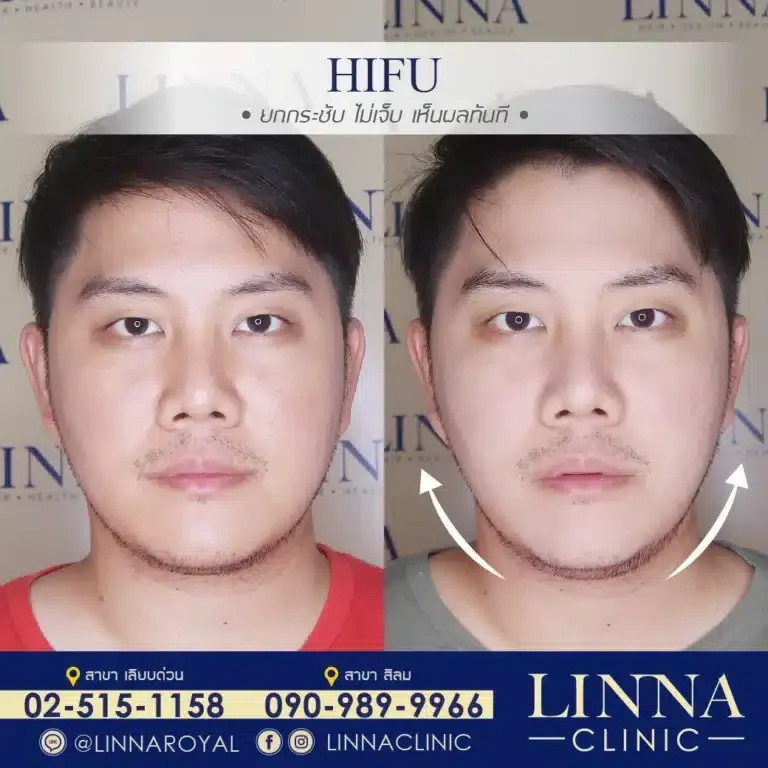 HIFU กับ MESO V Line A ต่างกันยังไงนะ