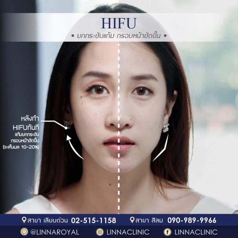 HIFU และ RF ยกกระชับหน้า ต่างกันอย่างไร เลือกทำแบบไหนดี