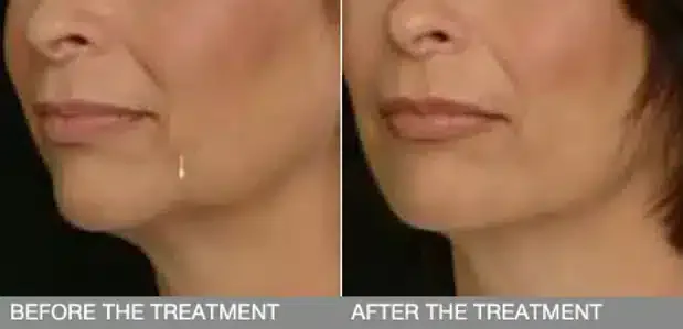 โบลิฟหน้าเหมือนการฉีดโบกรามรึเปล่า