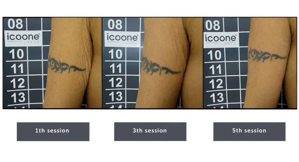 ลดสัดส่วน หุ่นดี ไม่ต้องผ่าตัด ด้วยโปรแกรม LINNA Body Sculpting by iCOONE® + CoolSwissPrime Plus