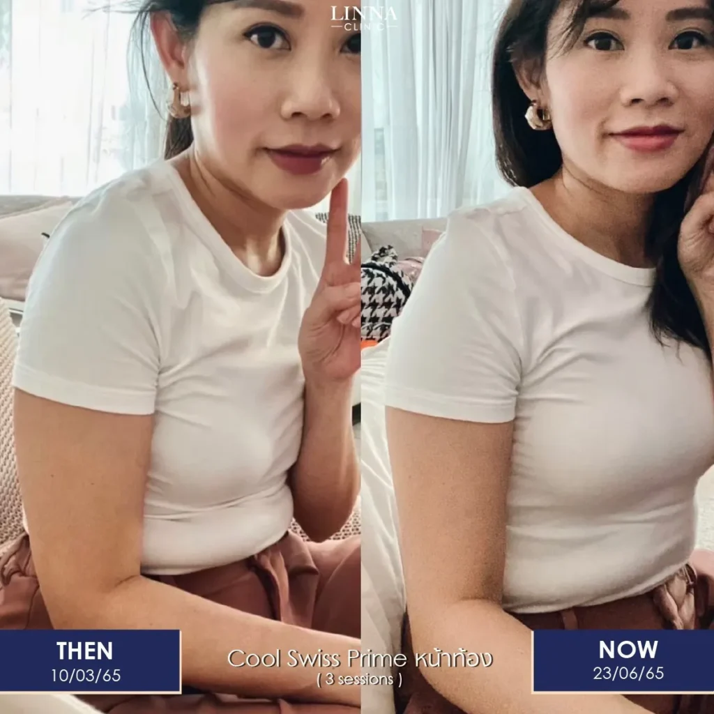 ลดสัดส่วน หุ่นดี ไม่ต้องผ่าตัด ด้วยโปรแกรม LINNA Body Sculpting by iCOONE® + CoolSwissPrime Plus