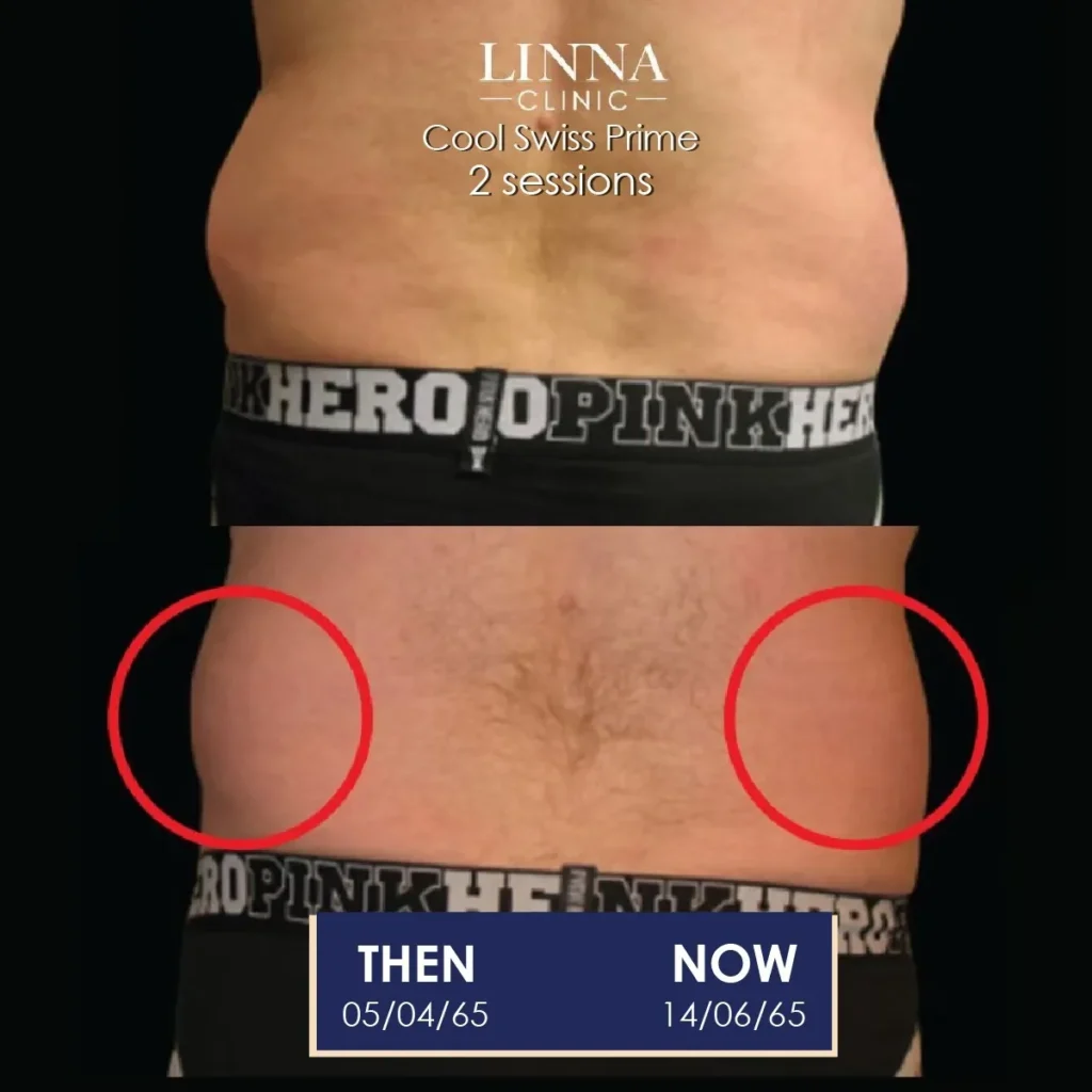 ลดสัดส่วน หุ่นดี ไม่ต้องผ่าตัด ด้วยโปรแกรม LINNA Body Sculpting by iCOONE® + CoolSwissPrime Plus