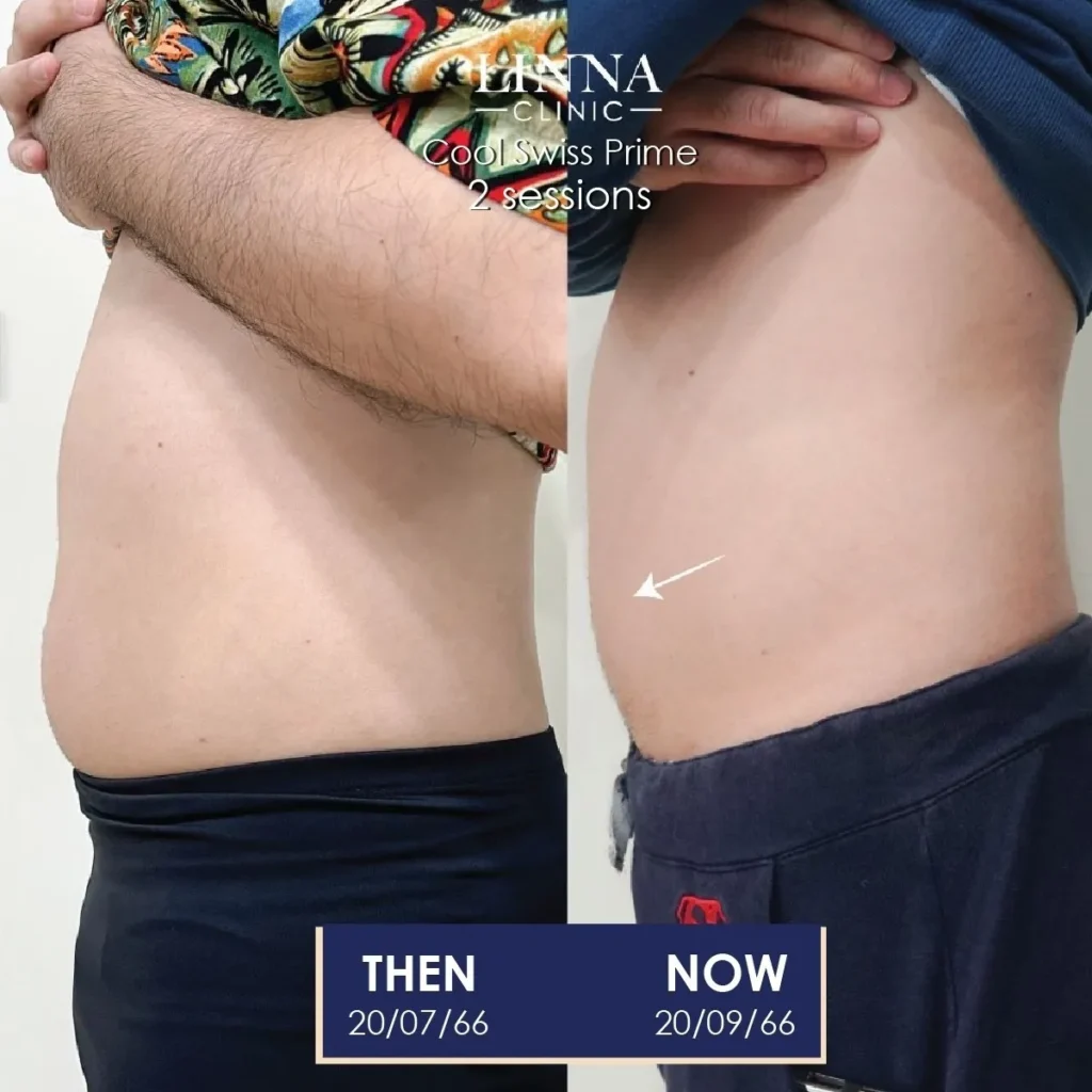 ลดสัดส่วน หุ่นดี ไม่ต้องผ่าตัด ด้วยโปรแกรม LINNA Body Sculpting by iCOONE® + CoolSwissPrime Plus