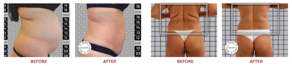 ลดสัดส่วน หุ่นดี ไม่ต้องผ่าตัด ด้วยโปรแกรม LINNA Body Sculpting by iCOONE® + CoolSwissPrime Plus
