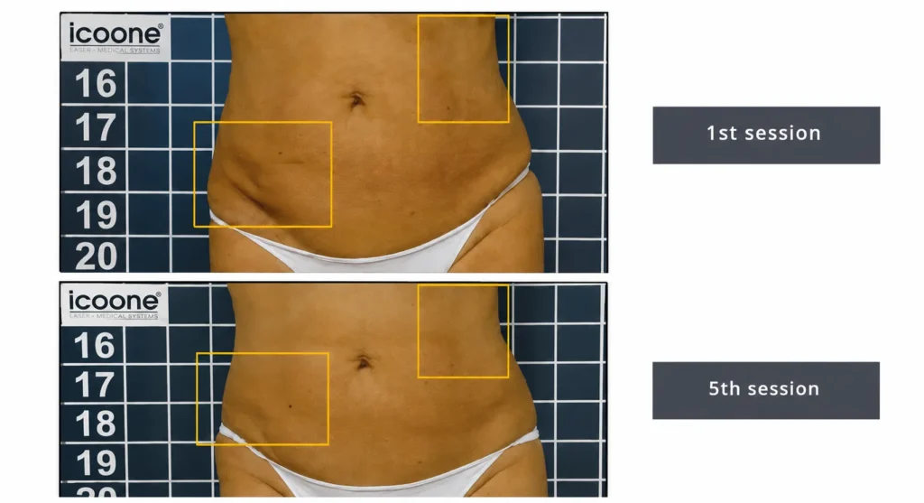 LINNA Body Sculpting by iCOONE® ลดสัดส่วน กระชับผิว ลดผิวเปลือกส้มแบบไม่ต้องพักฟื้นจากอิตาลี