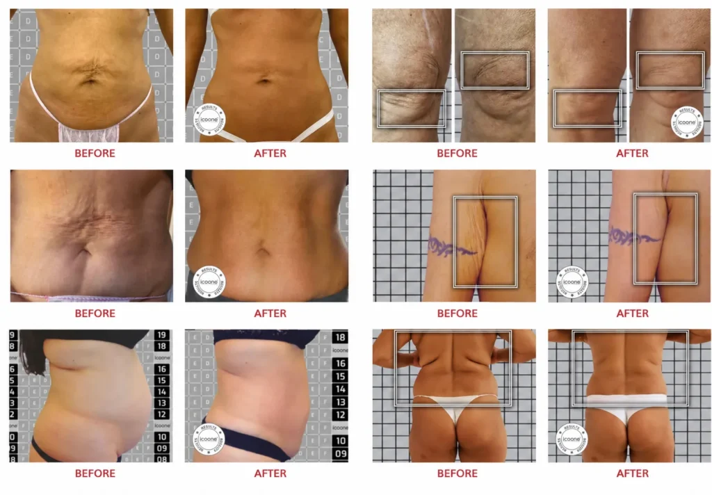 LINNA Body Sculpting by iCOONE® ลดสัดส่วน กระชับผิว ลดผิวเปลือกส้มแบบไม่ต้องพักฟื้นจากอิตาลี