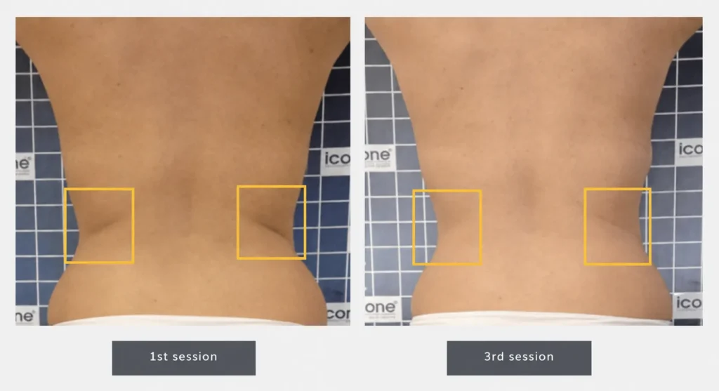 LINNA Body Sculpting by iCOONE® ลดสัดส่วน กระชับผิว ลดผิวเปลือกส้มแบบไม่ต้องพักฟื้นจากอิตาลี