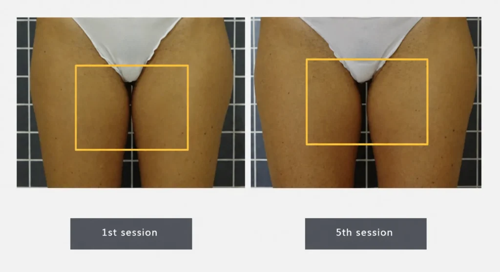 LINNA Body Sculpting by iCOONE® ลดสัดส่วน กระชับผิว ลดผิวเปลือกส้มแบบไม่ต้องพักฟื้นจากอิตาลี