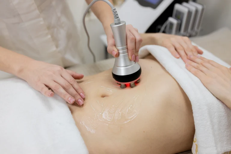 LINNA Body Sculpting by iCOONE® ลดสัดส่วน กระชับผิว ลดผิวเปลือกส้มแบบไม่ต้องพักฟื้นจากอิตาลี