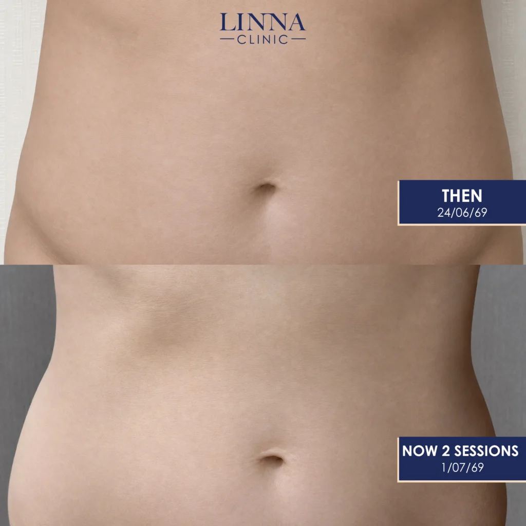 LINNA Body Sculpting by iCOONE® ลดสัดส่วน กระชับผิว ลดผิวเปลือกส้มแบบไม่ต้องพักฟื้นจากอิตาลี