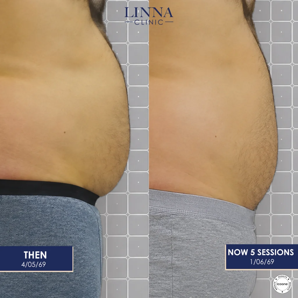 LINNA Body Sculpting by iCOONE® ลดสัดส่วน กระชับผิว ลดผิวเปลือกส้มแบบไม่ต้องพักฟื้นจากอิตาลี