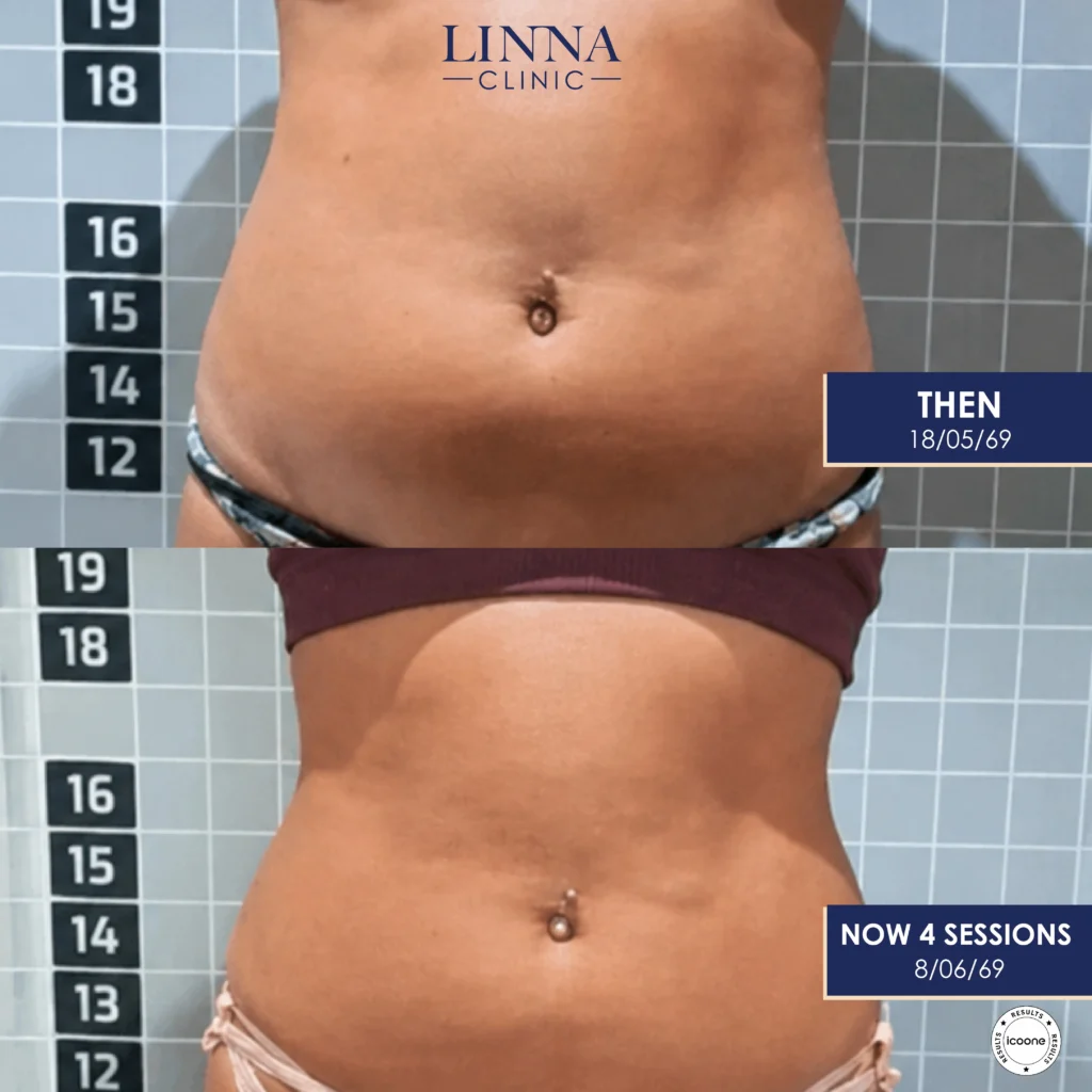 LINNA Body Sculpting by iCOONE® ลดสัดส่วน กระชับผิว ลดผิวเปลือกส้มแบบไม่ต้องพักฟื้นจากอิตาลี