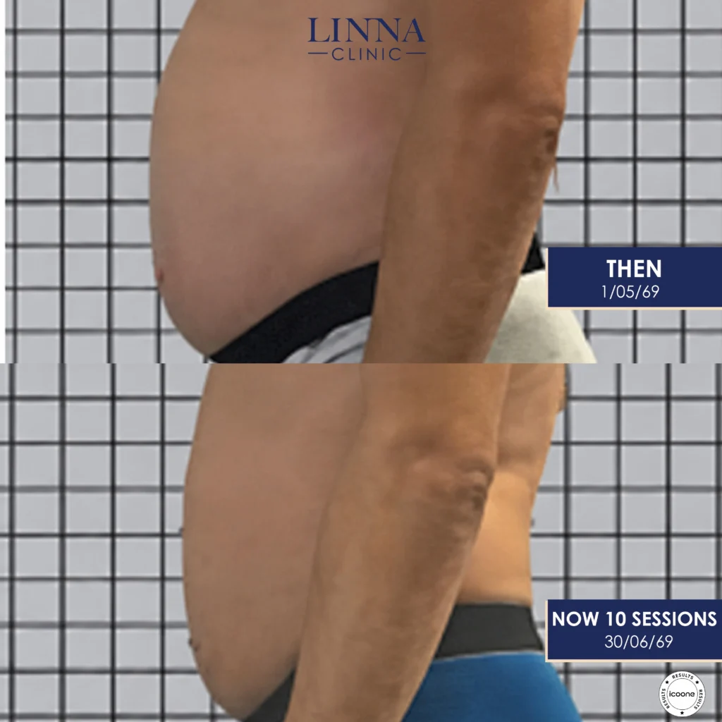 LINNA Body Sculpting by iCOONE® ลดสัดส่วน กระชับผิว ลดผิวเปลือกส้มแบบไม่ต้องพักฟื้นจากอิตาลี