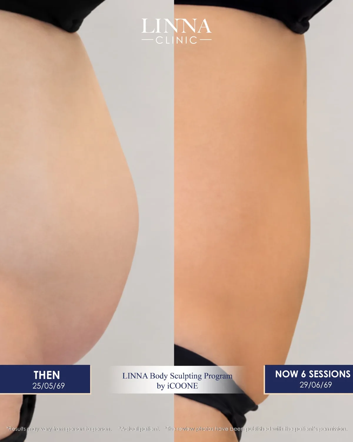 LINNA Body Sculpting by iCOONE®: تقنية إيطالية لنحت القوام وشد البشرة وتقليل مظهر السيلوليت دون فترة نقاهة