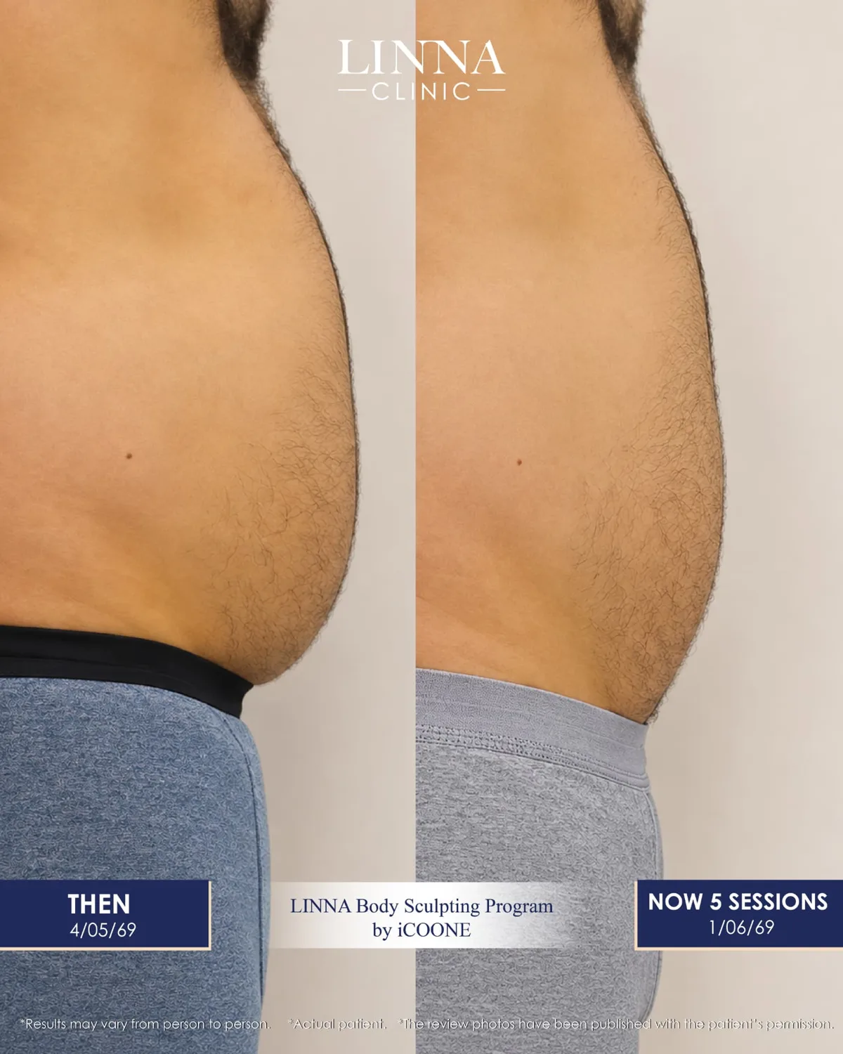 LINNA Body Sculpting by iCOONE®: تقنية إيطالية لنحت القوام وشد البشرة وتقليل مظهر السيلوليت دون فترة نقاهة