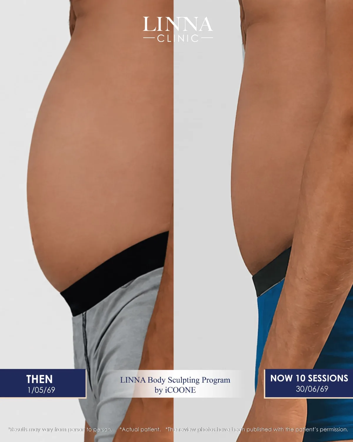 LINNA Body Sculpting by iCOONE®: تقنية إيطالية لنحت القوام وشد البشرة وتقليل مظهر السيلوليت دون فترة نقاهة