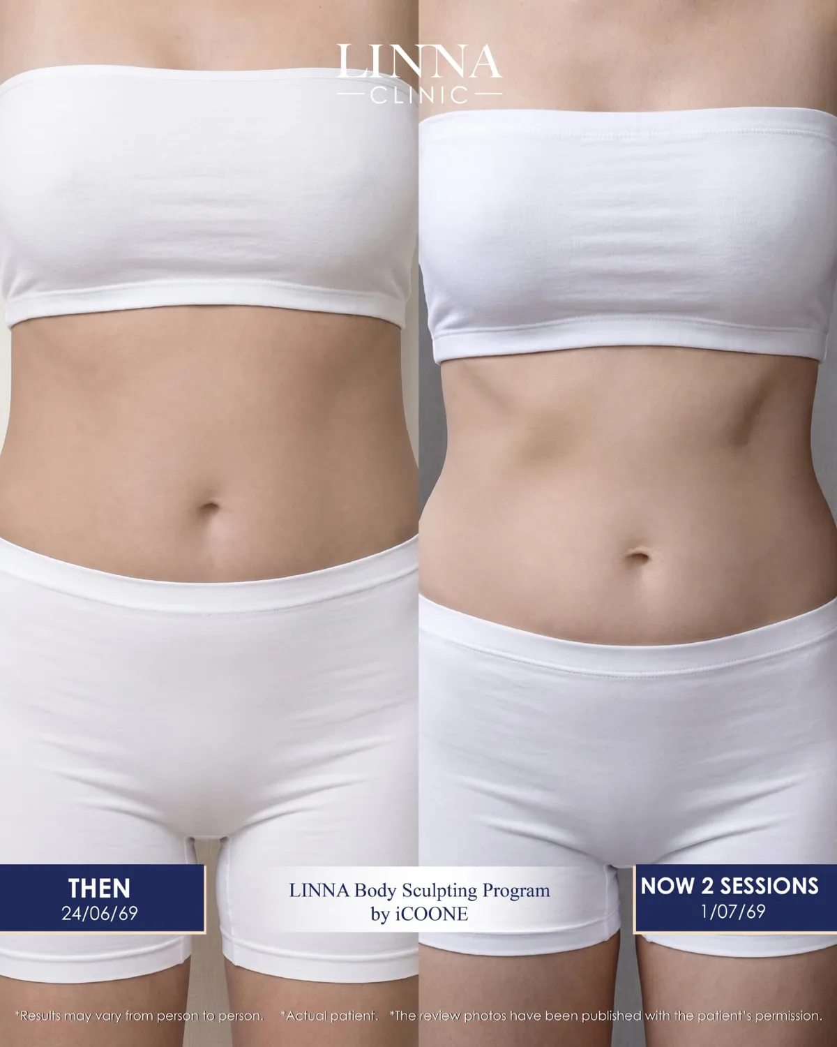 LINNA Body Sculpting by iCOONE® ลดสัดส่วน กระชับผิว ลดผิวเปลือกส้มแบบไม่ต้องพักฟื้นจากอิตาลี