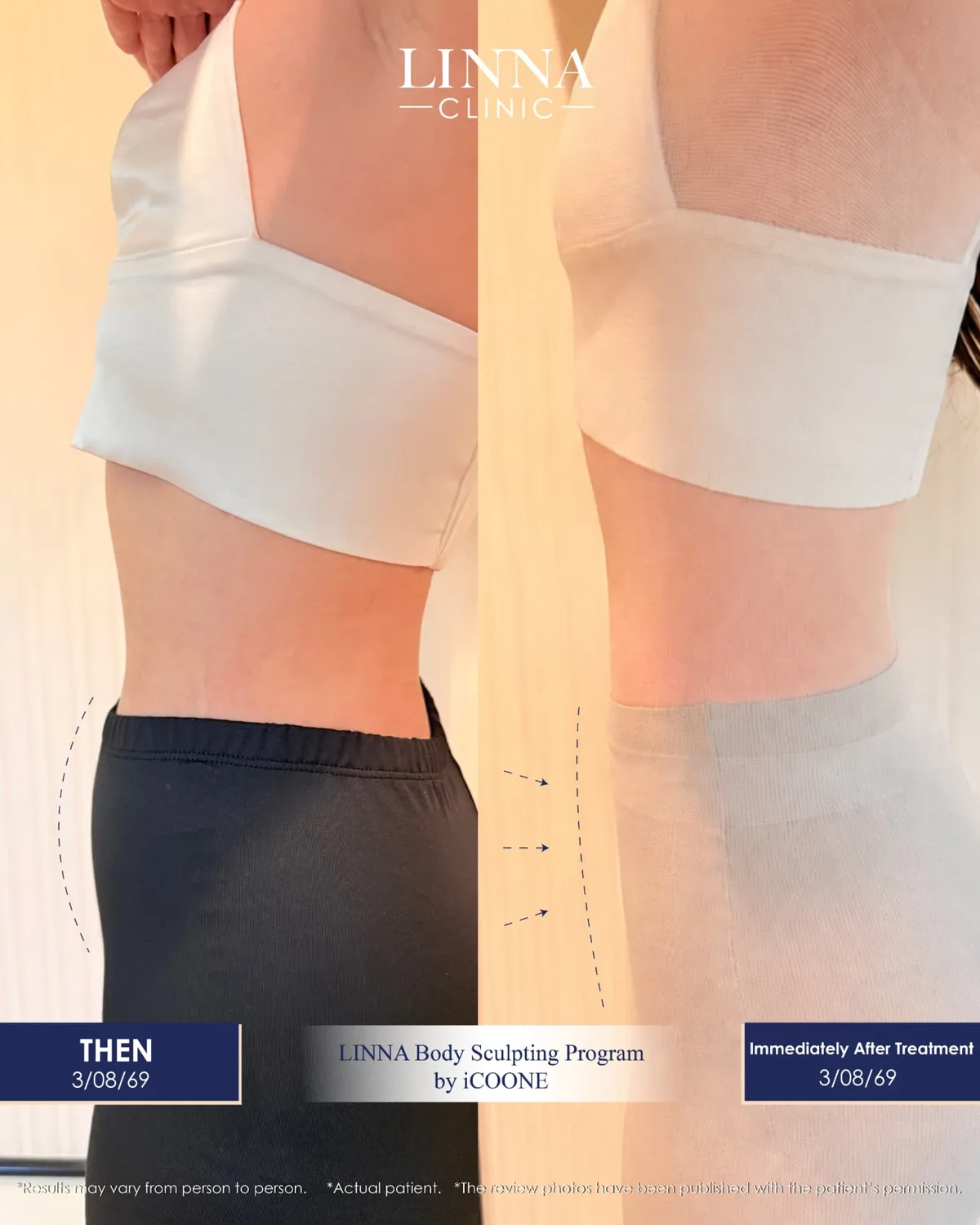 LINNA Body Sculpting by iCOONE® ลดสัดส่วน กระชับผิว ลดผิวเปลือกส้มแบบไม่ต้องพักฟื้นจากอิตาลี