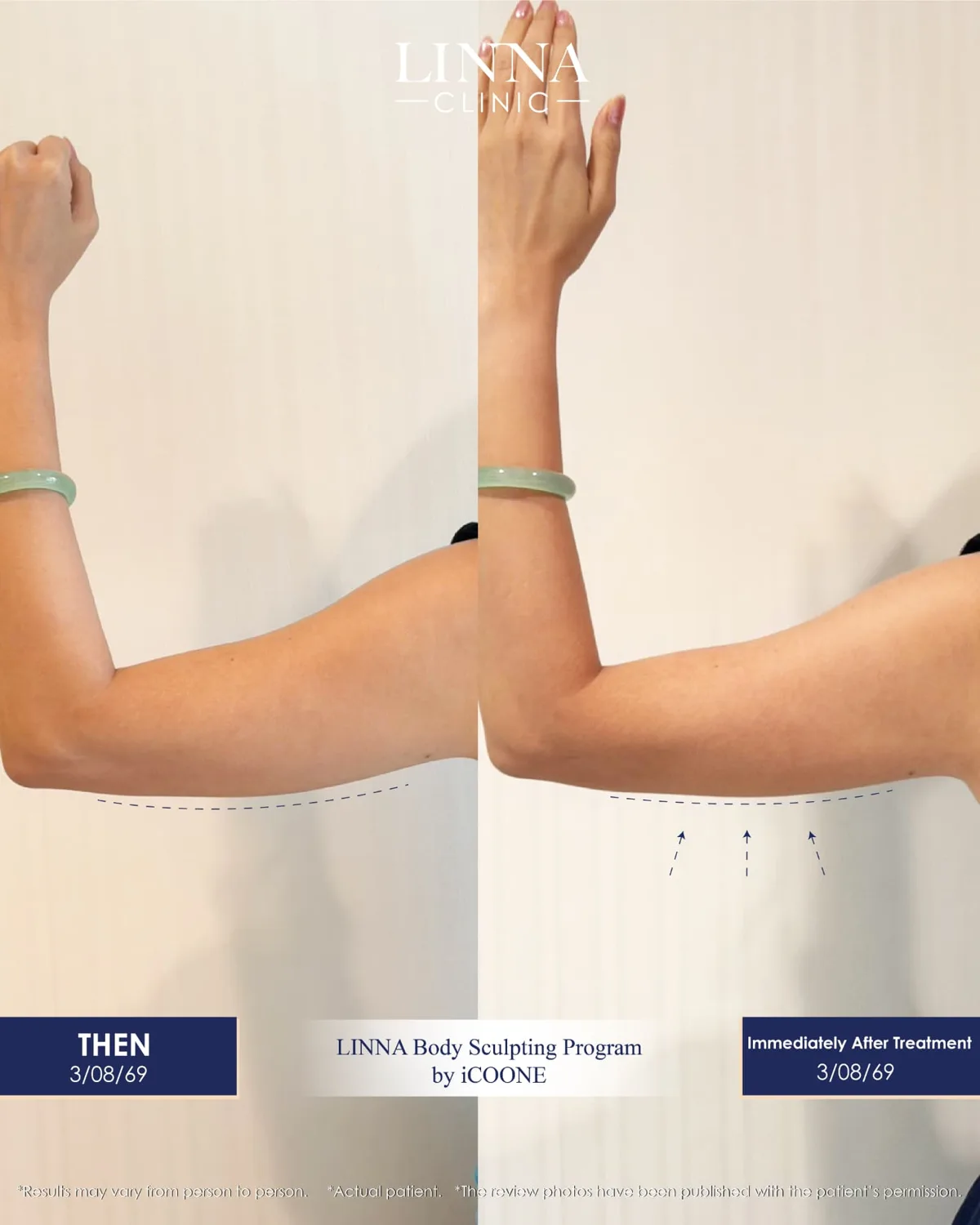 LINNA Body Sculpting by iCOONE®: تقنية إيطالية لنحت القوام وشد البشرة وتقليل مظهر السيلوليت دون فترة نقاهة