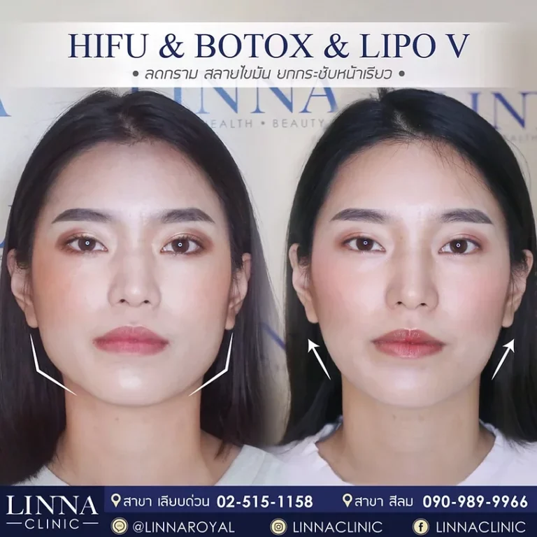 เมโสแฟตที่ LINNA แต่ละอันต่างกันยังไง