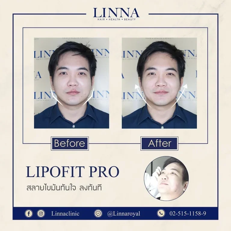 เมโสแฟตที่ LINNA แต่ละอันต่างกันยังไง
