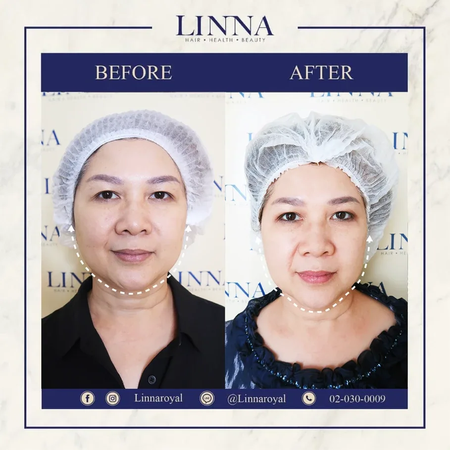 มาทำความเข้าใจ ระหว่าง Thermage กับ Ulthera กันเถอะ!